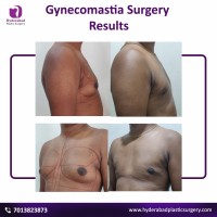 The best gynecomastia surgery in hyderabad